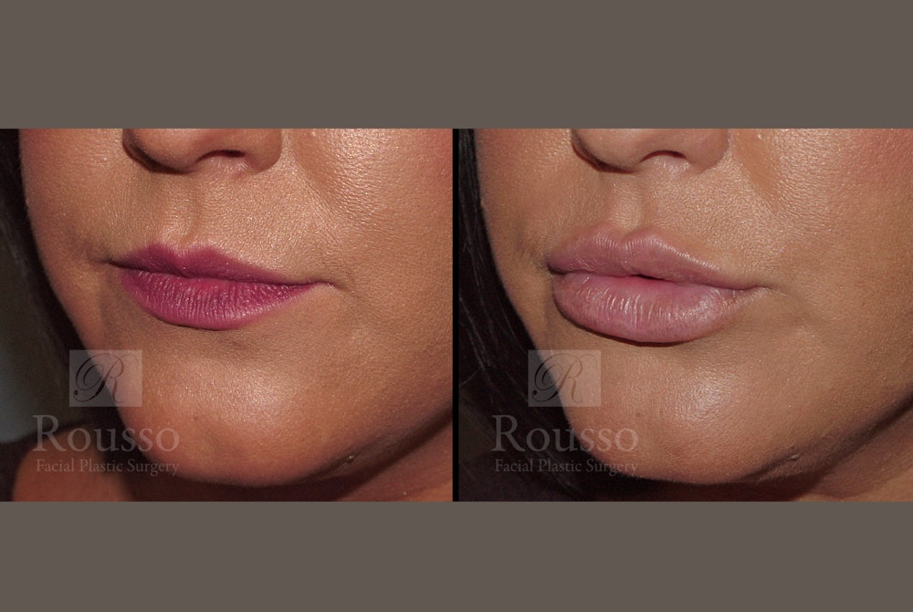 Fillers Before & After Gallery - Patient 52313943 - Image 2