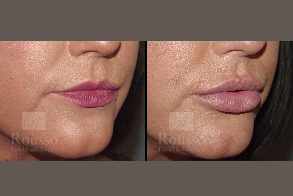 Fillers Before & After Gallery - Patient 52313943 - Image 3