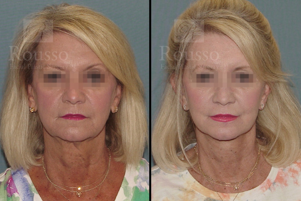 SculptLift™ <span class=small>By Dr. Daniel Rousso</span> Before & After Gallery - Patient 52313964 - Image 1