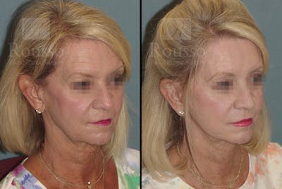 SculptLift™ Before & After Gallery - Patient 52313964 - Image 2