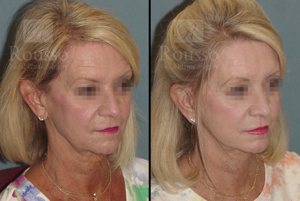 SculptLift™ Before & After Gallery - Patient 52313964 - Image 2