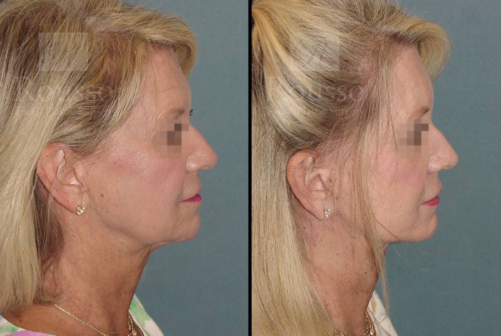 SculptLift™ Before & After Gallery - Patient 52313964 - Image 3