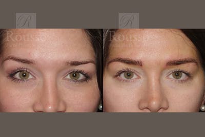 Microblading Before & After Gallery - Patient 52313981 - Image 1