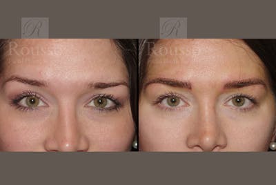 Microblading Gallery Before & After Gallery - Patient 52313981 - Image 1