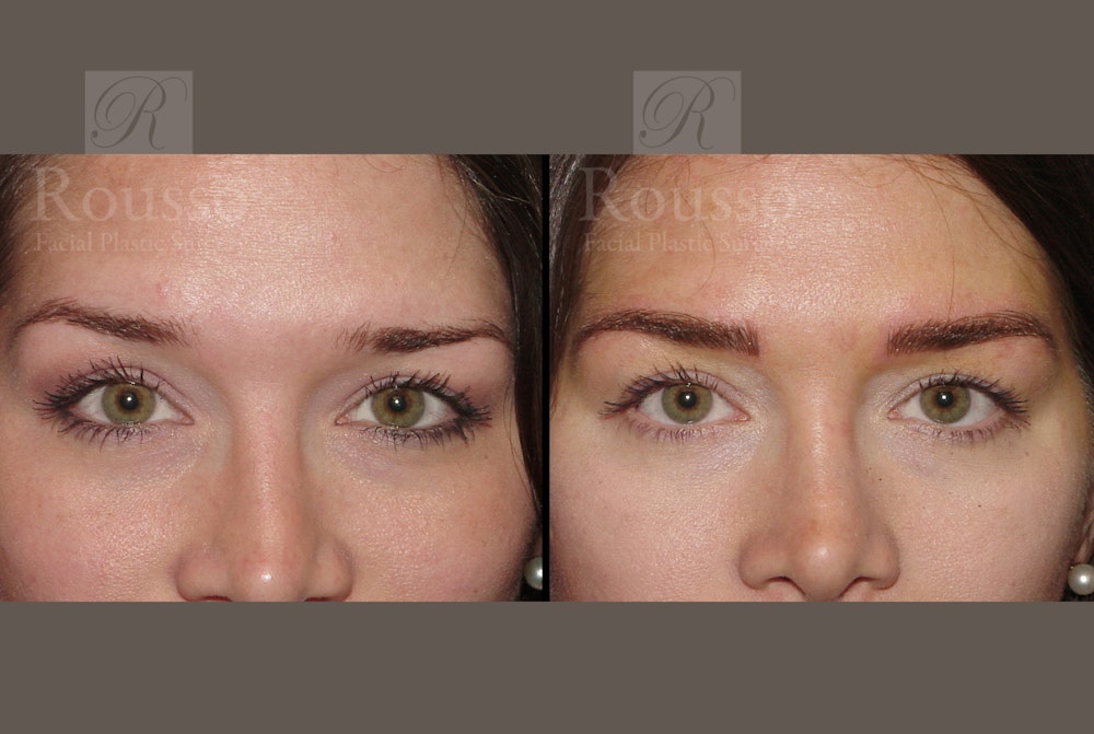 Microblading Gallery Before & After Gallery - Patient 52313981 - Image 1