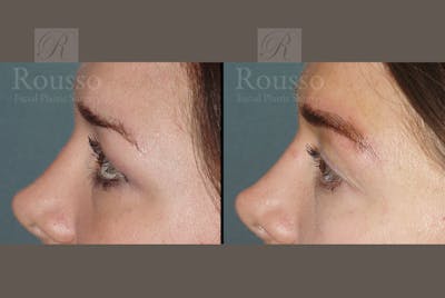 Microblading Gallery Before & After Gallery - Patient 52313981 - Image 2