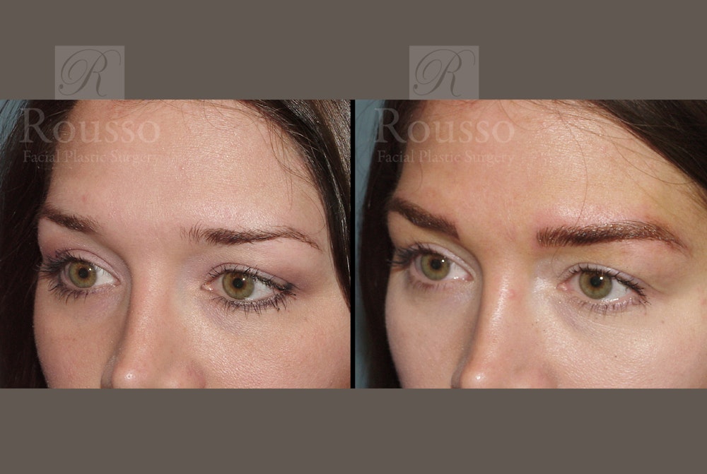 Microblading Gallery Before & After Gallery - Patient 52313981 - Image 3