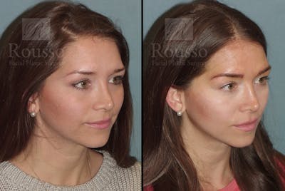 Microblading Gallery Before & After Gallery - Patient 52313981 - Image 4