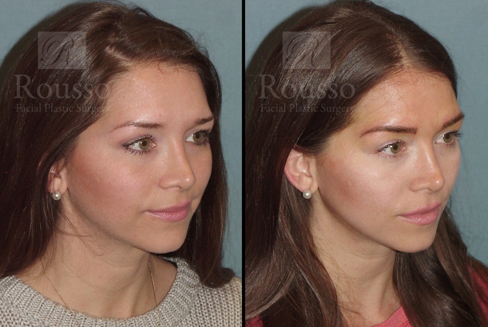 Microblading Gallery Before & After Gallery - Patient 52313981 - Image 4