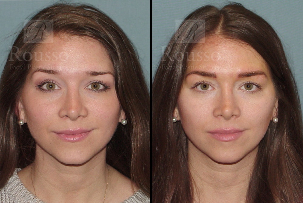 Microblading Before & After Gallery - Patient 52313981 - Image 5