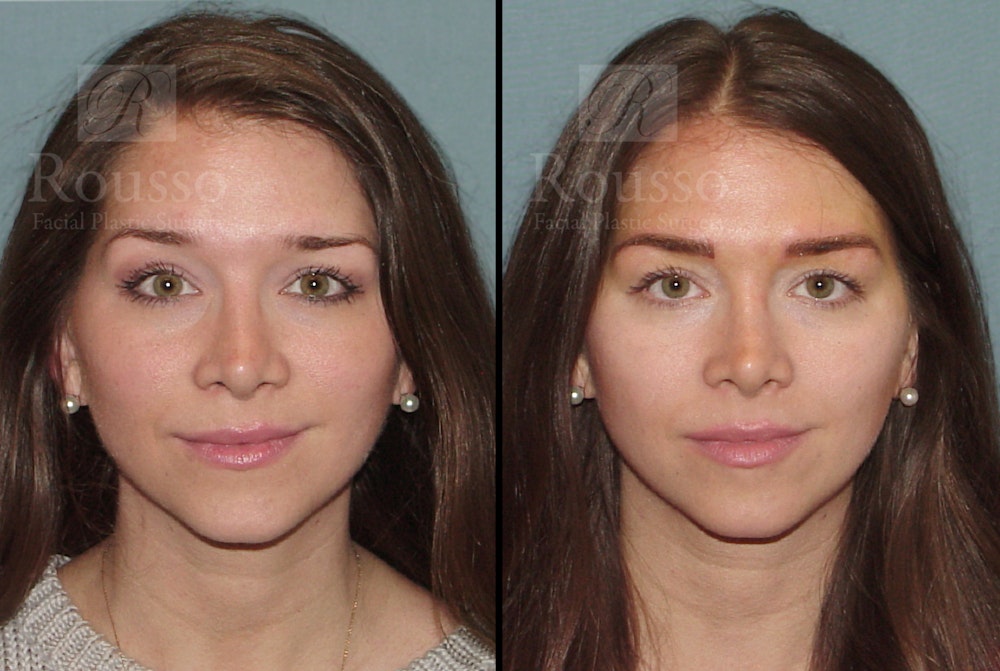 Microblading Gallery Before & After Gallery - Patient 52313981 - Image 5