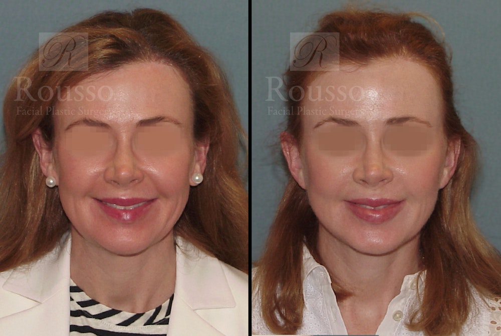 MiniLift Before & After Gallery - Patient 52520207 - Image 1