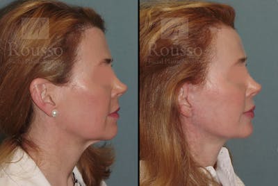 MiniLift Before & After Gallery - Patient 52520207 - Image 2