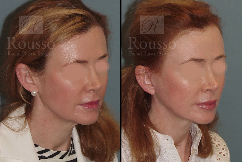 MiniLift Before & After Gallery - Patient 52520207 - Image 3