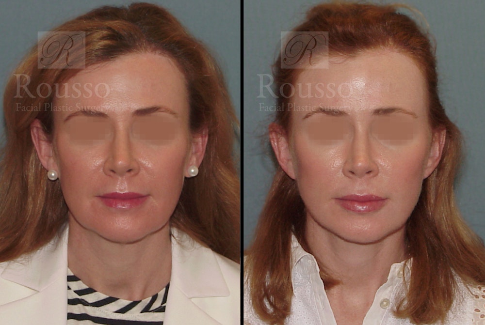 MiniLift Before & After Gallery - Patient 52520207 - Image 4