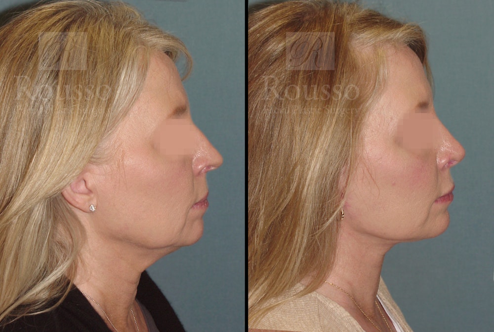 Facelift Before & After Gallery - Patient 52520227 - Image 3