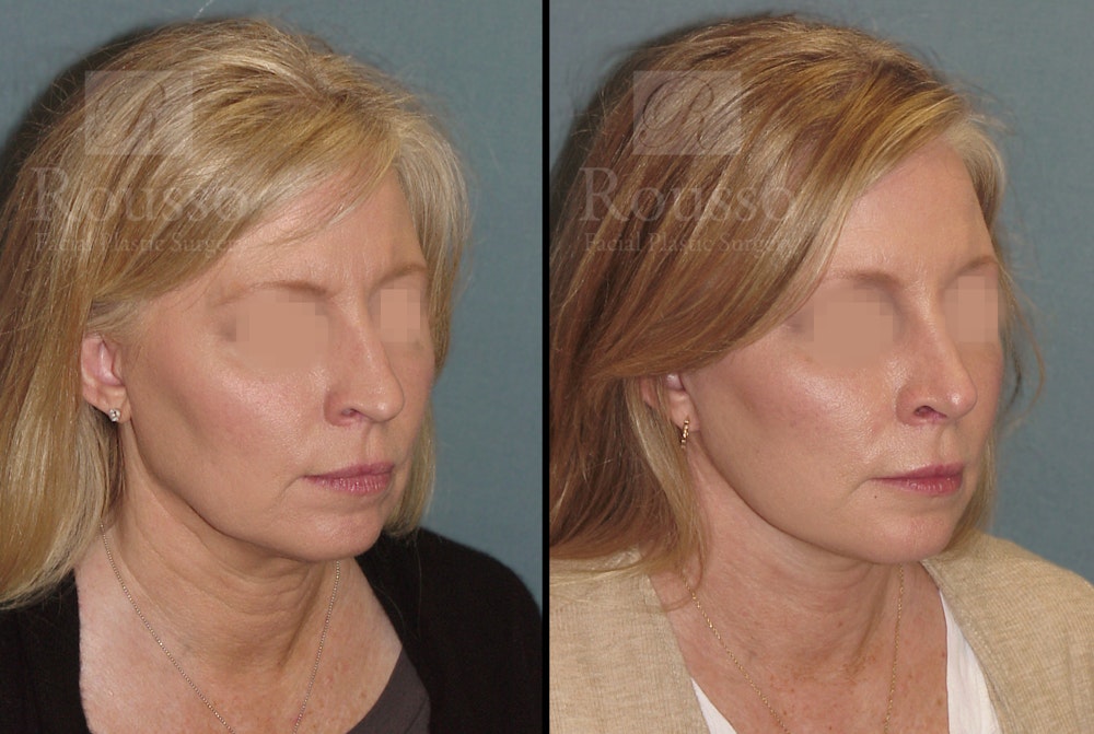 Facelift Before & After Gallery - Patient 52520227 - Image 1