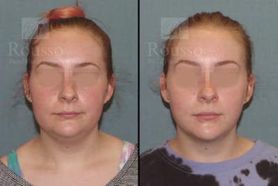 Acculift Before & After Gallery - Patient 53239072 - Image 1