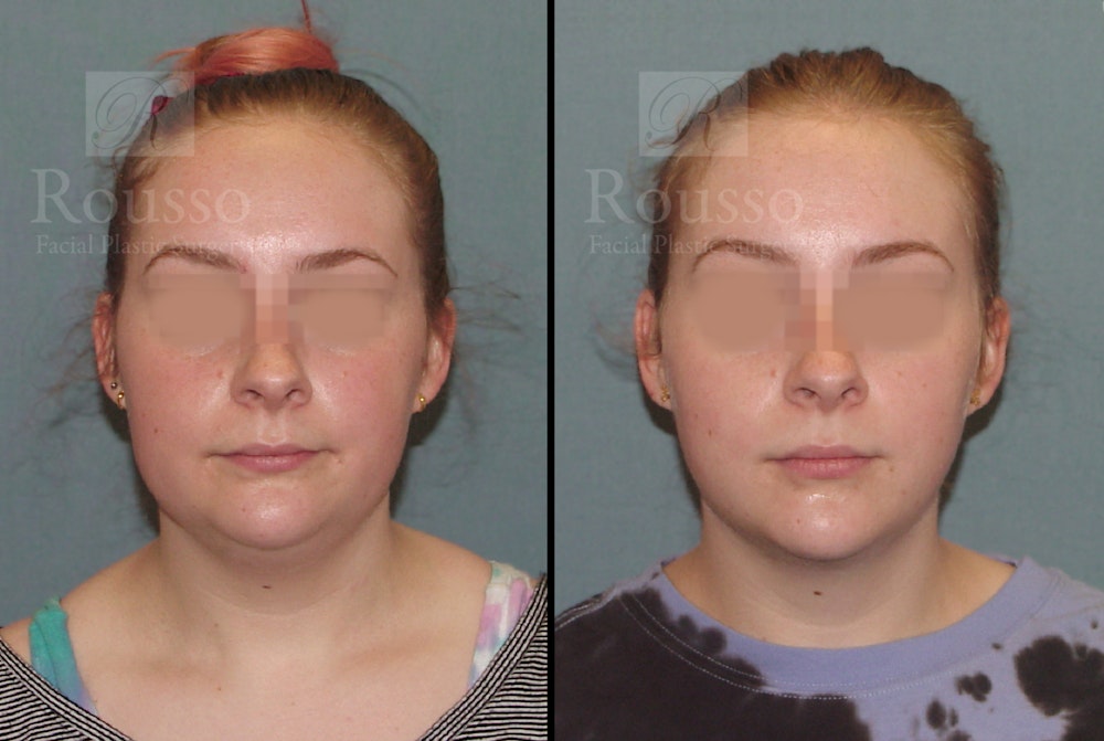 Acculift Before & After Gallery - Patient 53239072 - Image 1