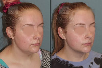 Acculift Before & After Gallery - Patient 53239072 - Image 2