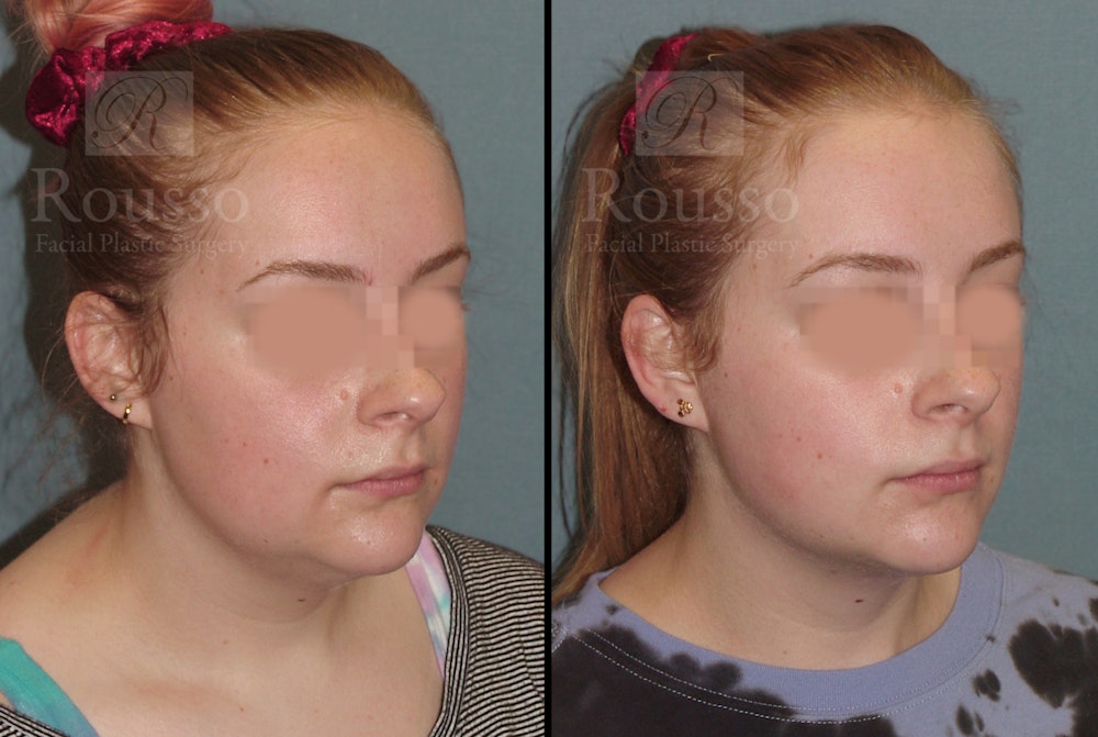 Acculift Before & After Gallery - Patient 53239072 - Image 2