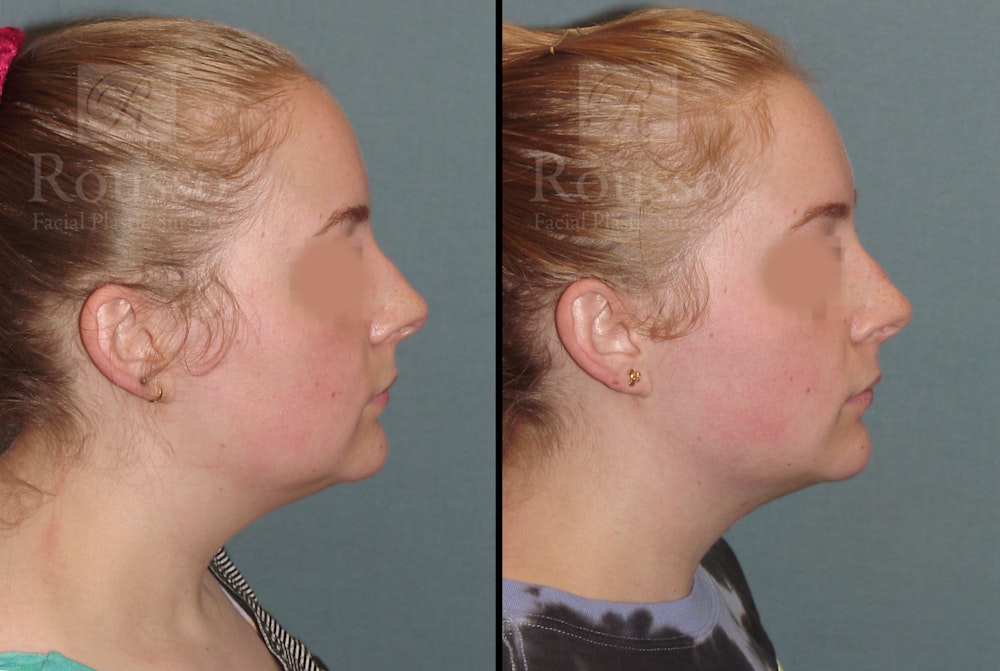 Acculift Before & After Gallery - Patient 53239072 - Image 3