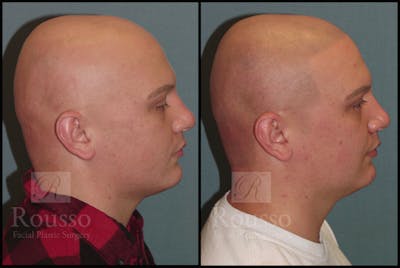 Scalp MicroPigmentation Before & After Gallery - Patient 6385036 - Image 1