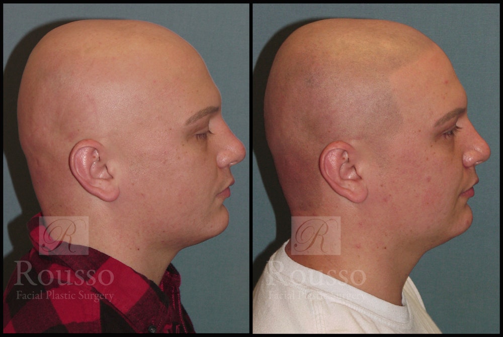 Scalp MicroPigmentation Before & After Gallery - Patient 6385036 - Image 1