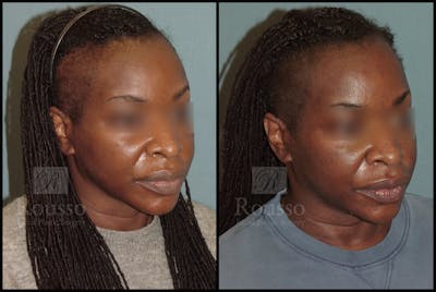 Scalp MicroPigmentation Before & After Gallery - Patient 54683848 - Image 1