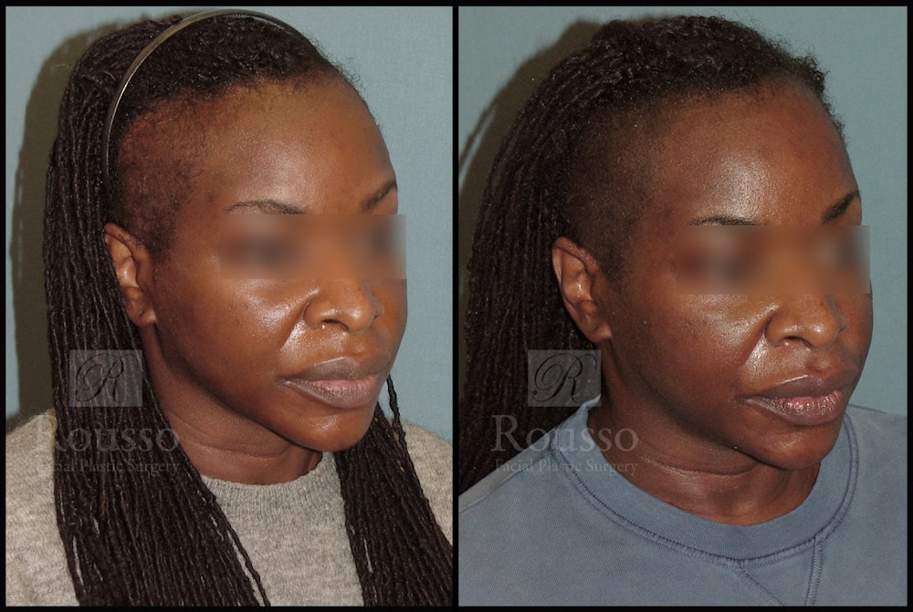 Scalp MicroPigmentation Before & After Gallery - Patient 54683848 - Image 1