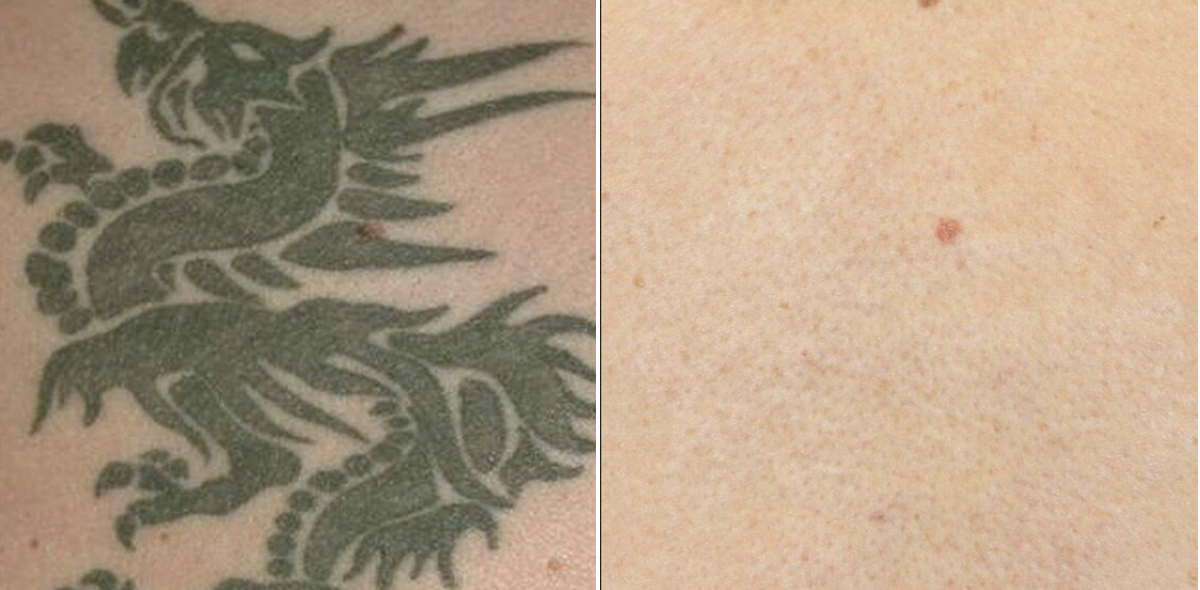 Aggregate more than 55 tattoo removal birmingham al latest in.cdgdbentre