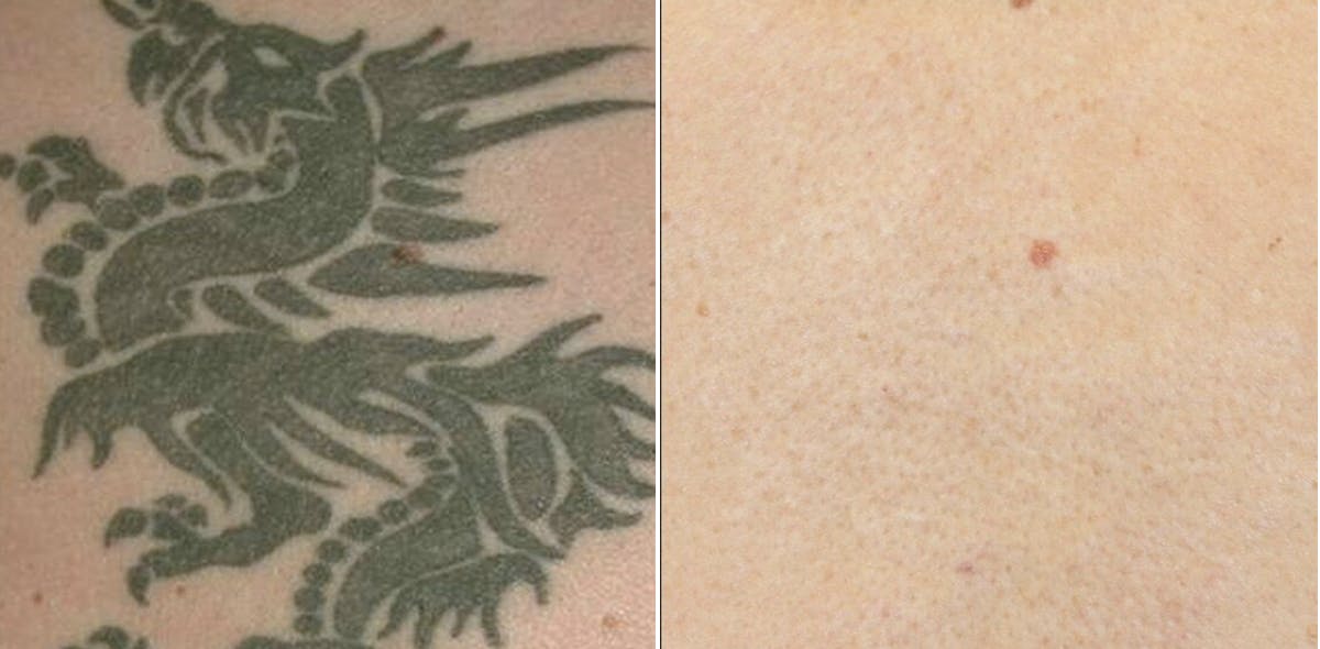 Before and after laser tattoo removal