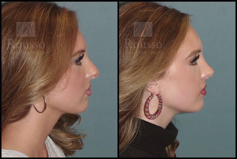 Rhinoplasty Before & After Gallery - Patient 92151794 - Image 1