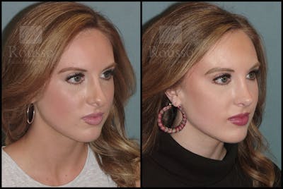 Rhinoplasty <span class=small>By Dr. Daniel Rousso</span> Before & After Gallery - Patient 92151794 - Image 2
