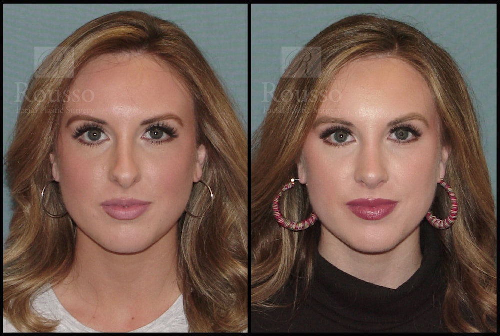 Rhinoplasty <span class=small>By Dr. Daniel Rousso</span> Before & After Gallery - Patient 92151794 - Image 3