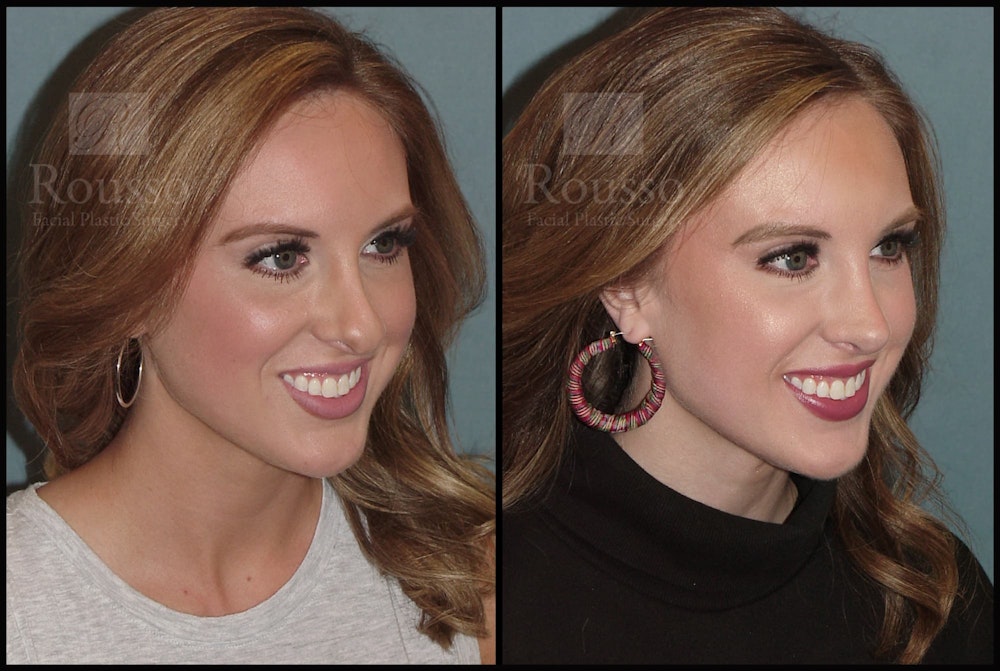Rhinoplasty Before & After Gallery - Patient 92151794 - Image 4