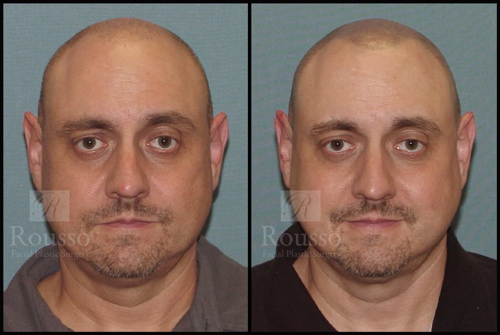 Scalp MicroPigmentation Before & After Gallery - Patient 92151797 - Image 1