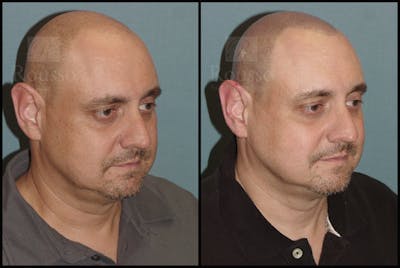 Scalp MicroPigmentation Before & After Gallery - Patient 92151797 - Image 2