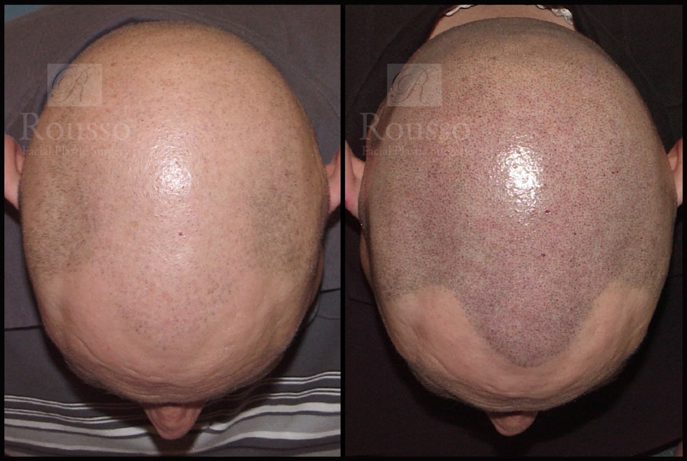 Scalp MicroPigmentation Before & After Gallery - Patient 92151797 - Image 3