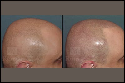Scalp MicroPigmentation Before & After Gallery - Patient 92151797 - Image 4