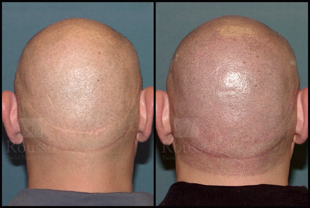 Scalp MicroPigmentation Before & After Gallery - Patient 92151797 - Image 5