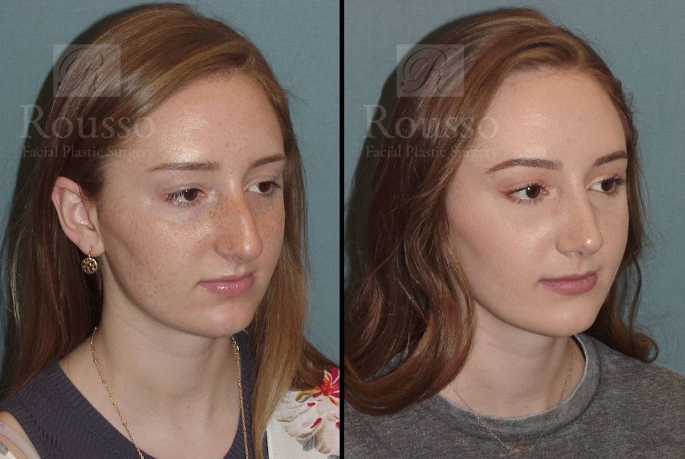 Rhinoplasty Before & After Gallery - Patient 102905525 - Image 1