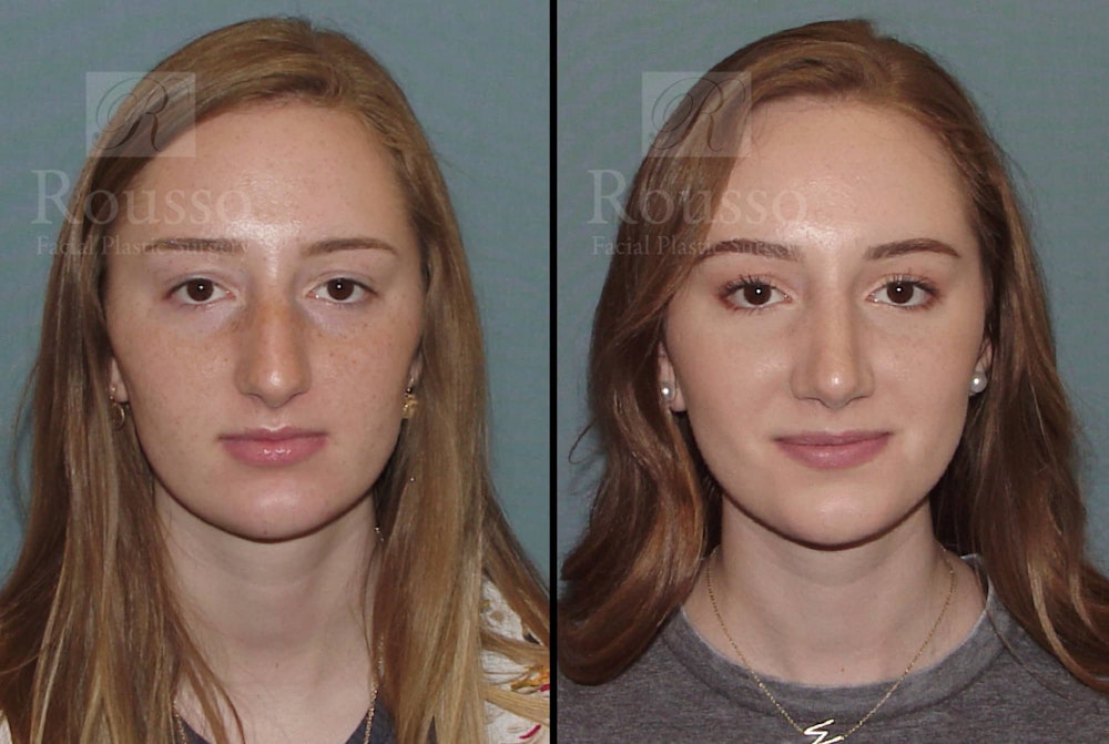 Rhinoplasty Before & After Gallery - Patient 102905525 - Image 3