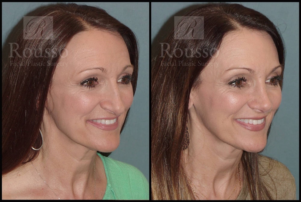 Rhinoplasty Before & After Gallery - Patient 102905526 - Image 2