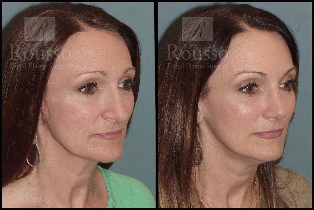 Rhinoplasty Before & After Gallery - Patient 102905526 - Image 2