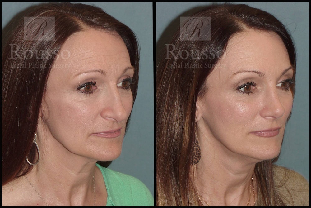 Rhinoplasty <span class=small>By Dr. Daniel Rousso</span> Before & After Gallery - Patient 102905526 - Image 3