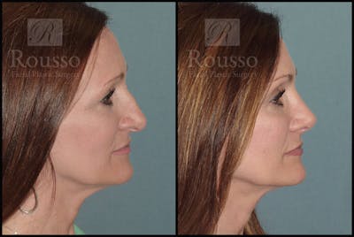 Rhinoplasty <span class=small>By Dr. Daniel Rousso</span> Before & After Gallery - Patient 102905526 - Image 1