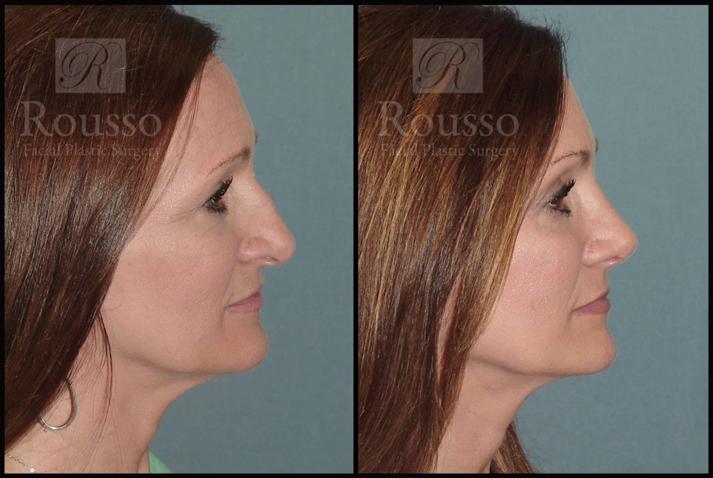 Rhinoplasty Before & After Gallery - Patient 102905526 - Image 3