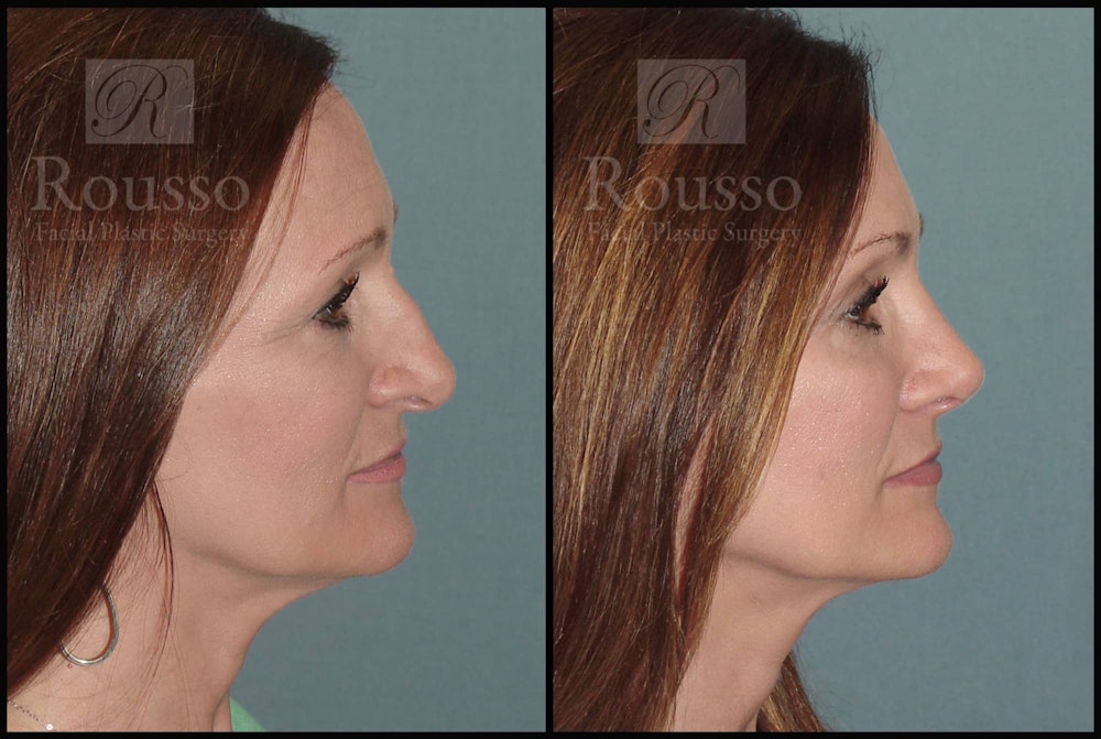 Rhinoplasty <span class=small>By Dr. Daniel Rousso</span> Before & After Gallery - Patient 102905526 - Image 1