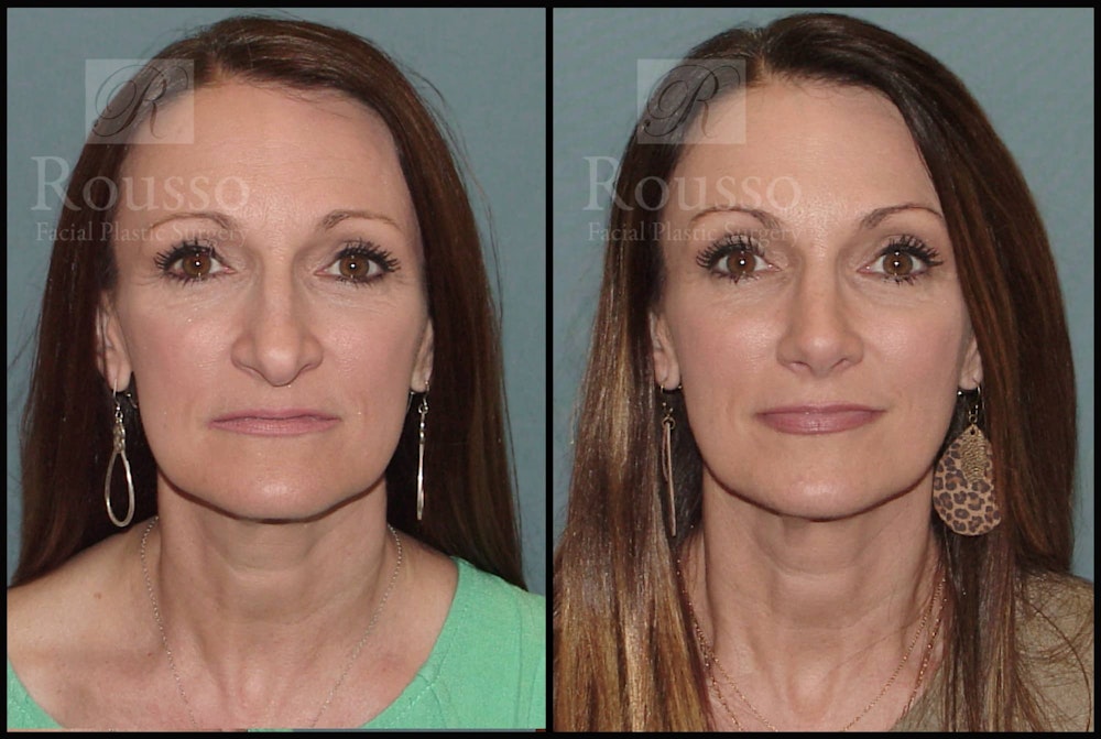 Rhinoplasty <span class=small>By Dr. Daniel Rousso</span> Before & After Gallery - Patient 102905526 - Image 4